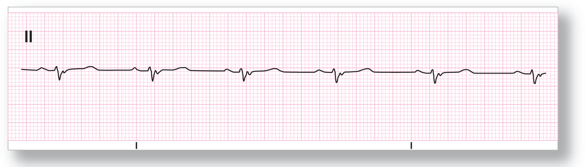 A rhythm strip from lead 2 shows a sharp dip of the QRS complex between two short and subtle curves of the P and T waves.