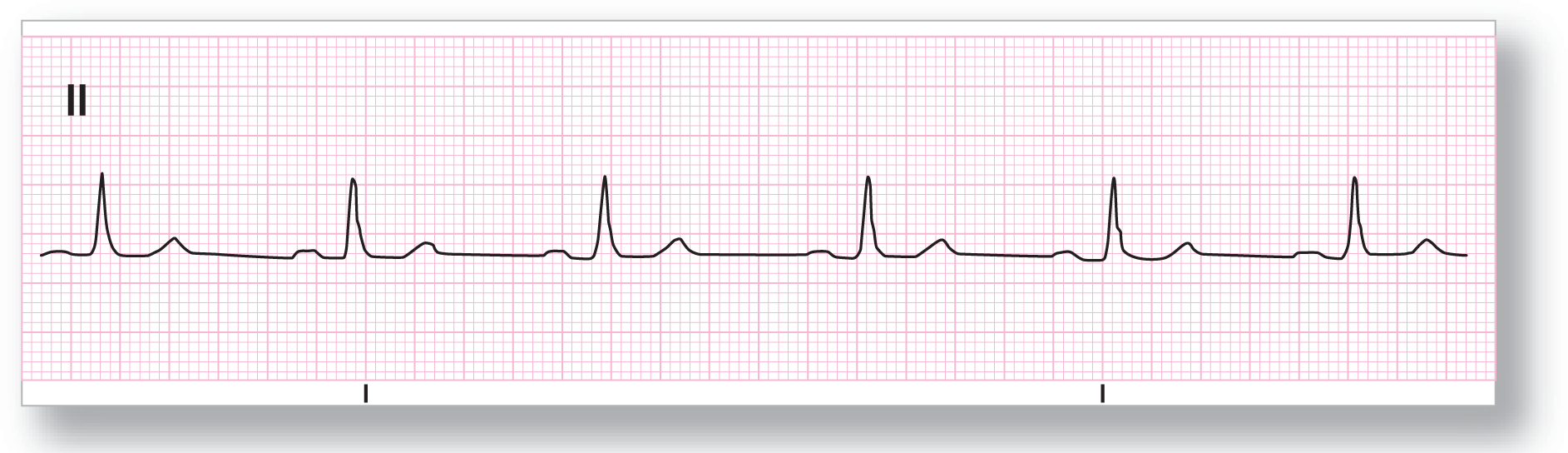 A rhythm strip from lead 2 shows sharp peaks of the QRS complex between two short and subtle curves of the P and T waves.