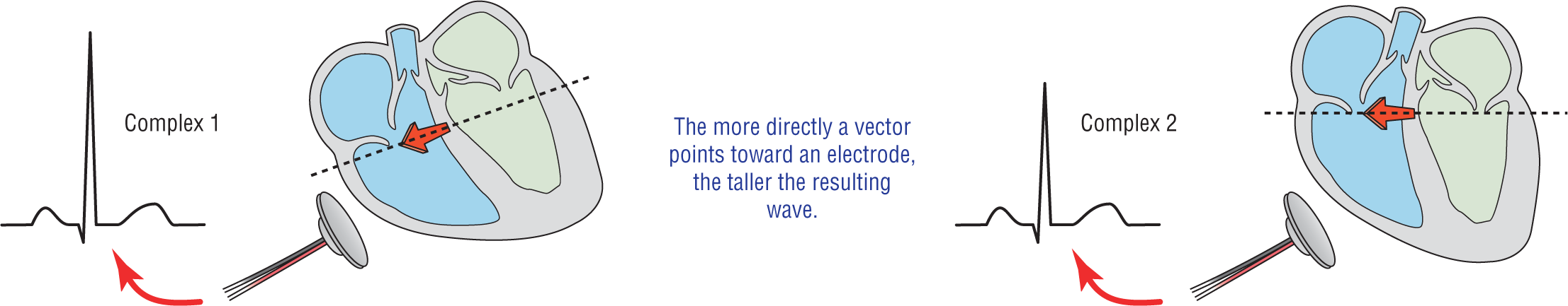 An illustration shows the cause of occurrence of electrical alternans.