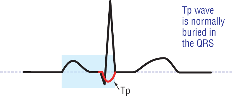 An illustration shows a normal ECG complex. A small depressed wave is across the QRS complex. Text reads, “Tp wave is normally buried in the QRS.”