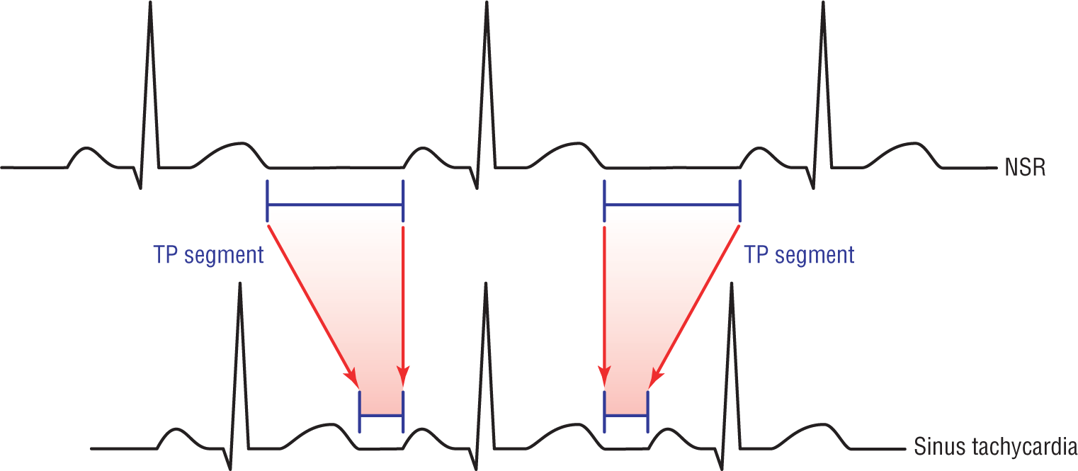 An illustration shows two ECG complexes comparing NSR and sinus tachycardia. The TP segment is shorter in sinus tachycardia than in NSR.