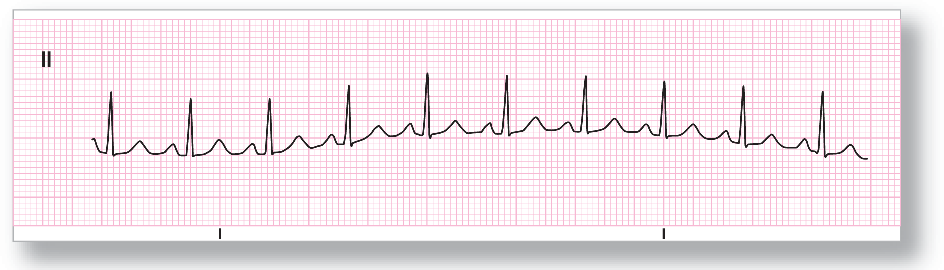 A rhythm strip from lead 2 shows a tall peak of the QRS complex between two short peaks of the P and T waves. The baseline rises and then falls.