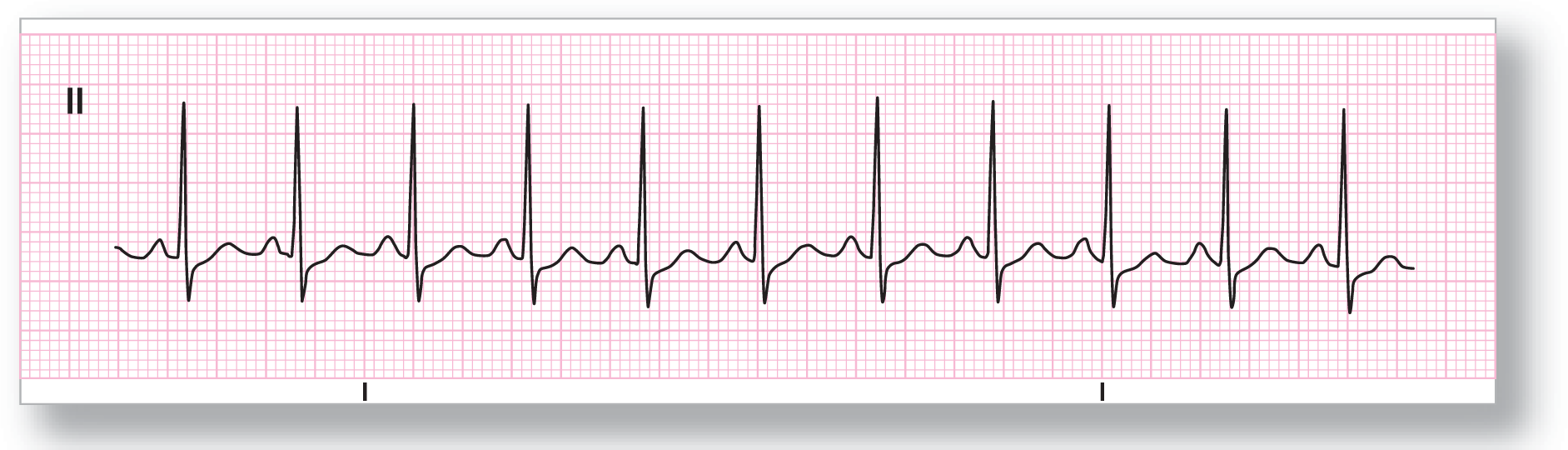 A rhythm strip from lead 2 shows a short, curved peak of the P wave, a tall, sharp peak of the R wave, a sharp dip of the S wave, and a subtle, curved peak of the T wave.