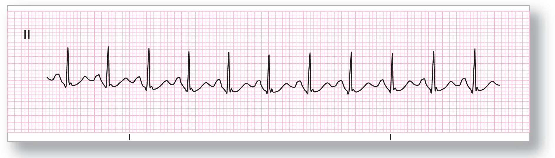 A rhythm strip from lead 2 shows a tall, sharp peak of the QRS complex between two irregular short and curved peaks of the P and T waves. There is a small notch at the lower point of the QRS complex.