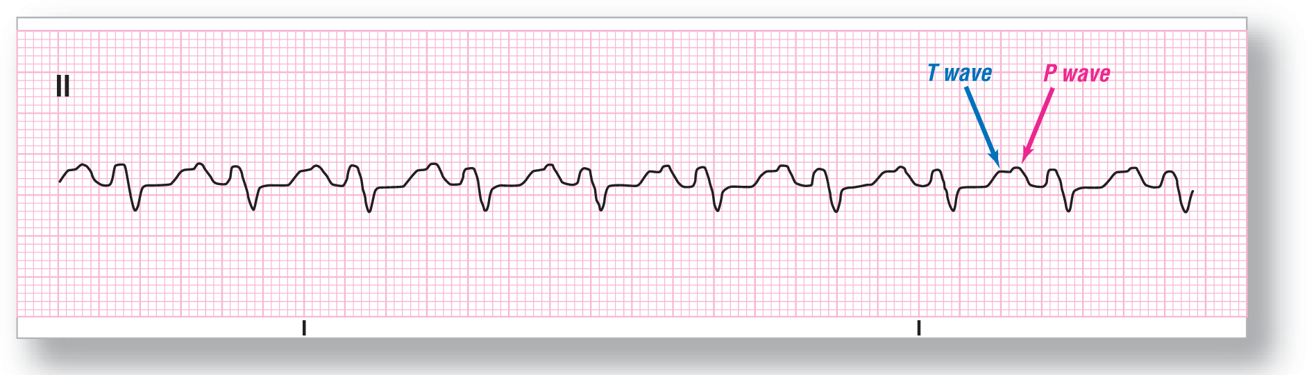 A rhythm strip from lead 2 shows a short, curved peak of the R wave, a short, curved dip of the S wave, and a raised plateau with a notch. T wave is to the left of the notch, while P wave is to the right.