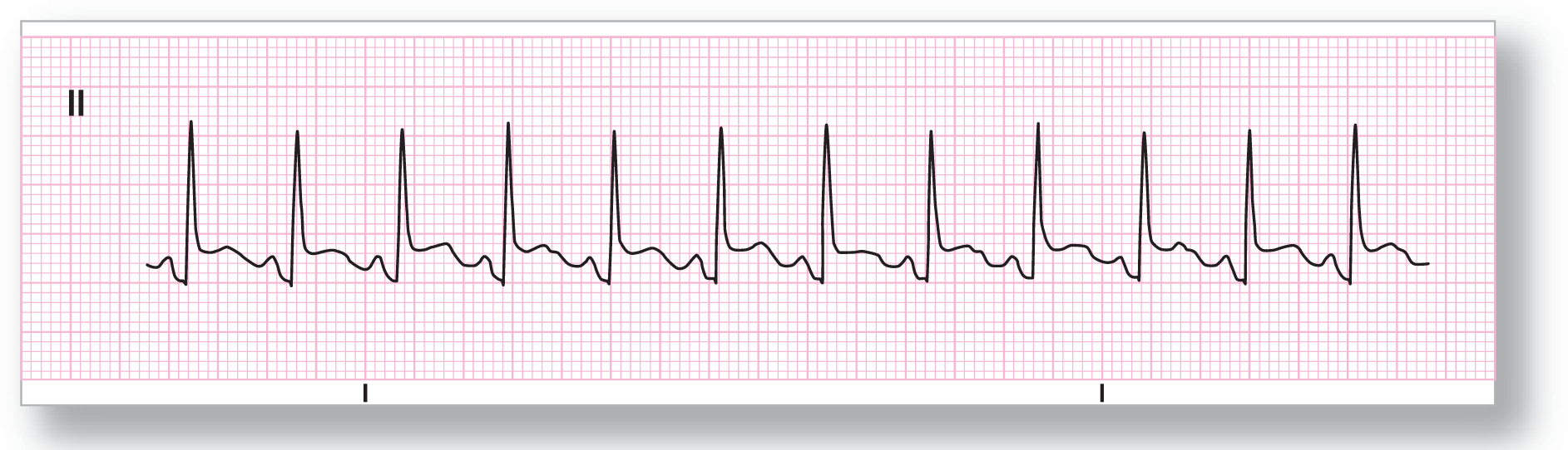 A rhythm strip from lead 2 shows a curved dip of the P wave, a tall, sharp peak of the QRS complex, which dips and leads to a plateau, and a curved peak of the T wave.