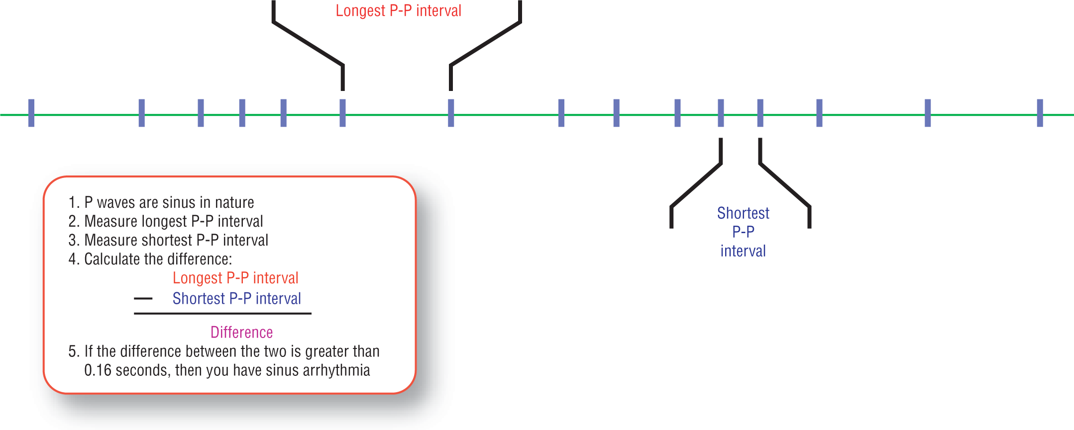 An illustration shows the process of identifying sinus arrhythmia.