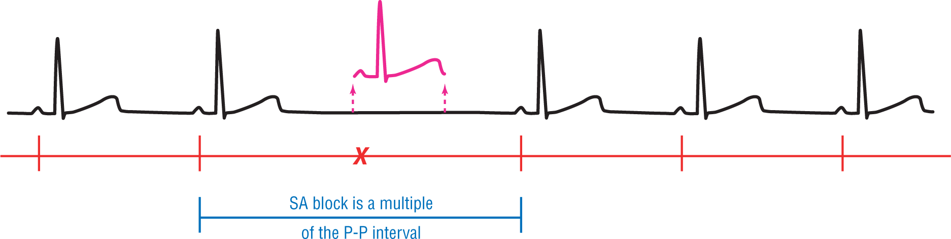 An illustration shows a normal rhythm pattern with a missing beat. The P-P interval between the beats on either side of the missing one is labeled, “SA block is a multiple of the P-P interval.”