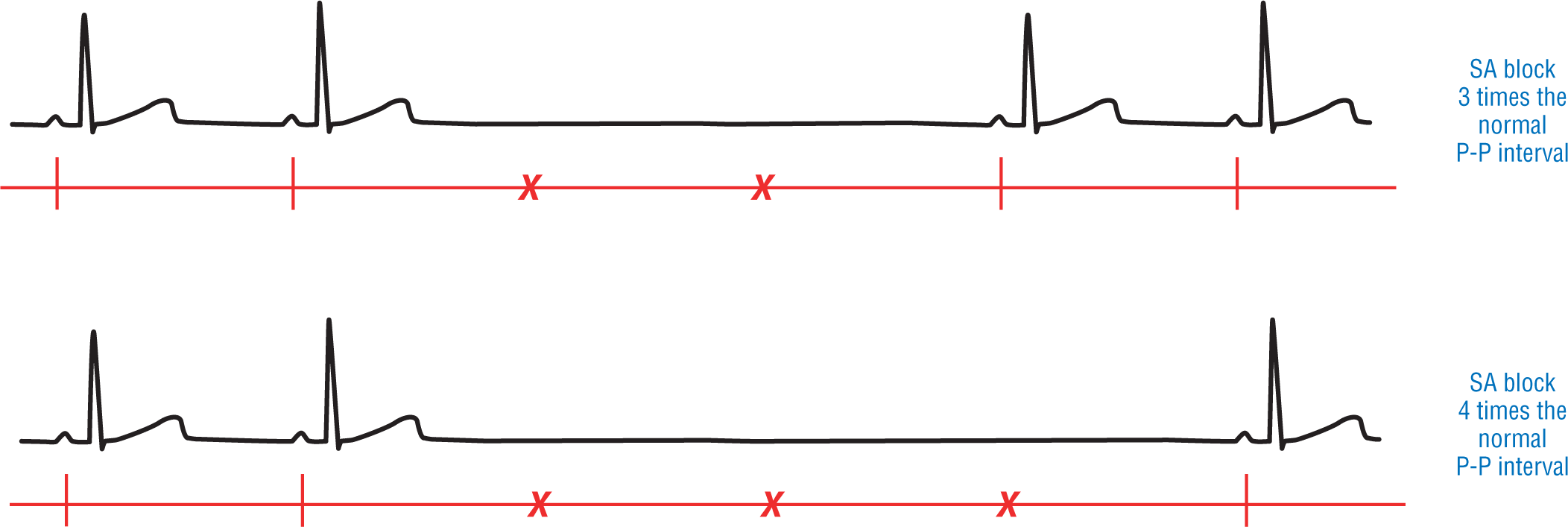 Two illustrations show examples of different types of sinus block.