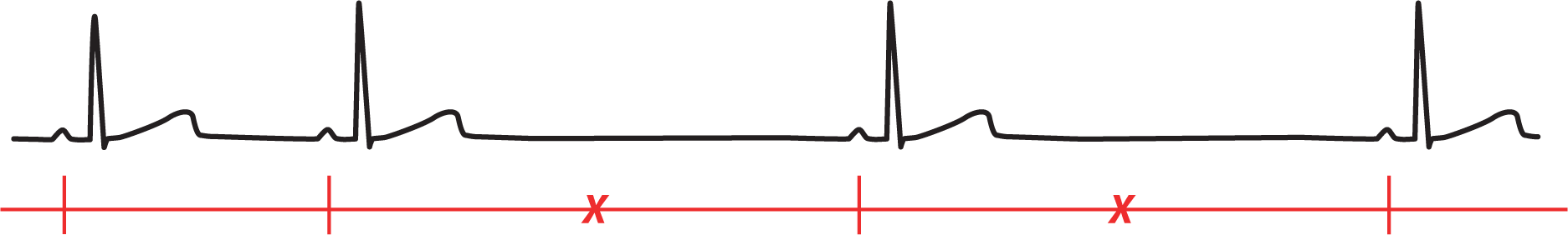 An illustration shows a normal rhythm pattern measuring P-P intervals and with alternating missing beats.