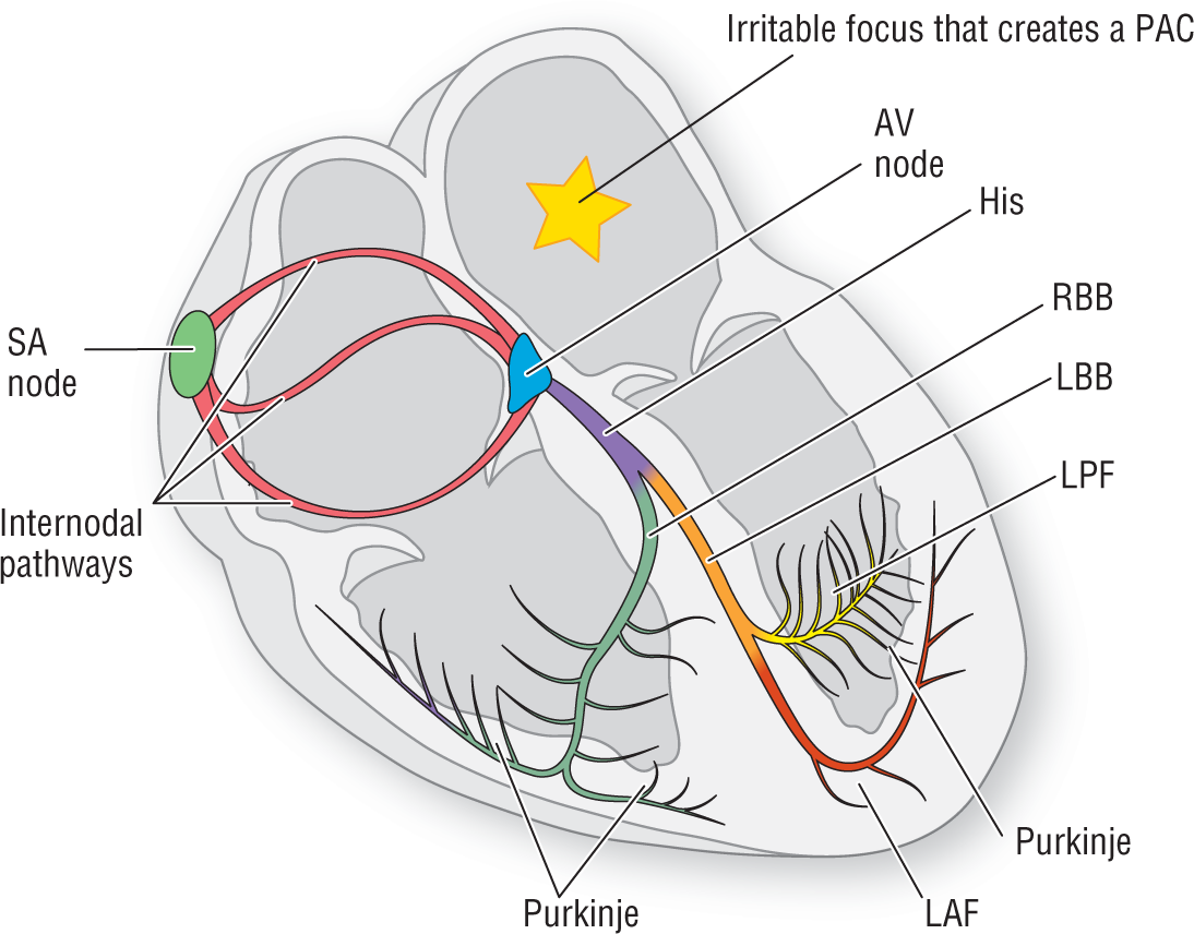 An illustration shows the electrical conduction system of the heart. An irritable focus that creates a PAC is in the left atrium.