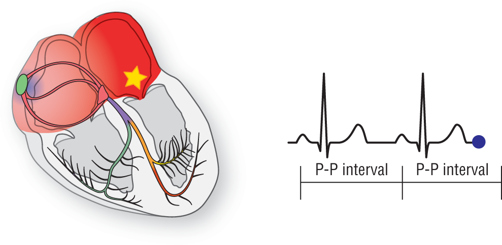 An illustration of the heart shows the atria highlighted. An ectopic focus is in the lower left atrium. Accompanying ECG is normal with regular P-P intervals.