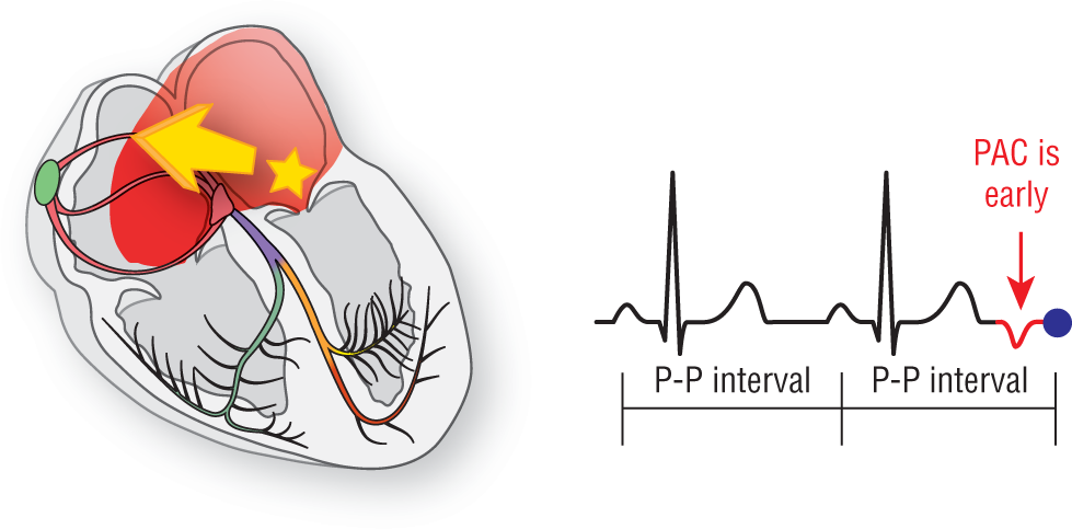 An illustration of the heart shows the effect on ECG pattern when an ectopic focus fires early.