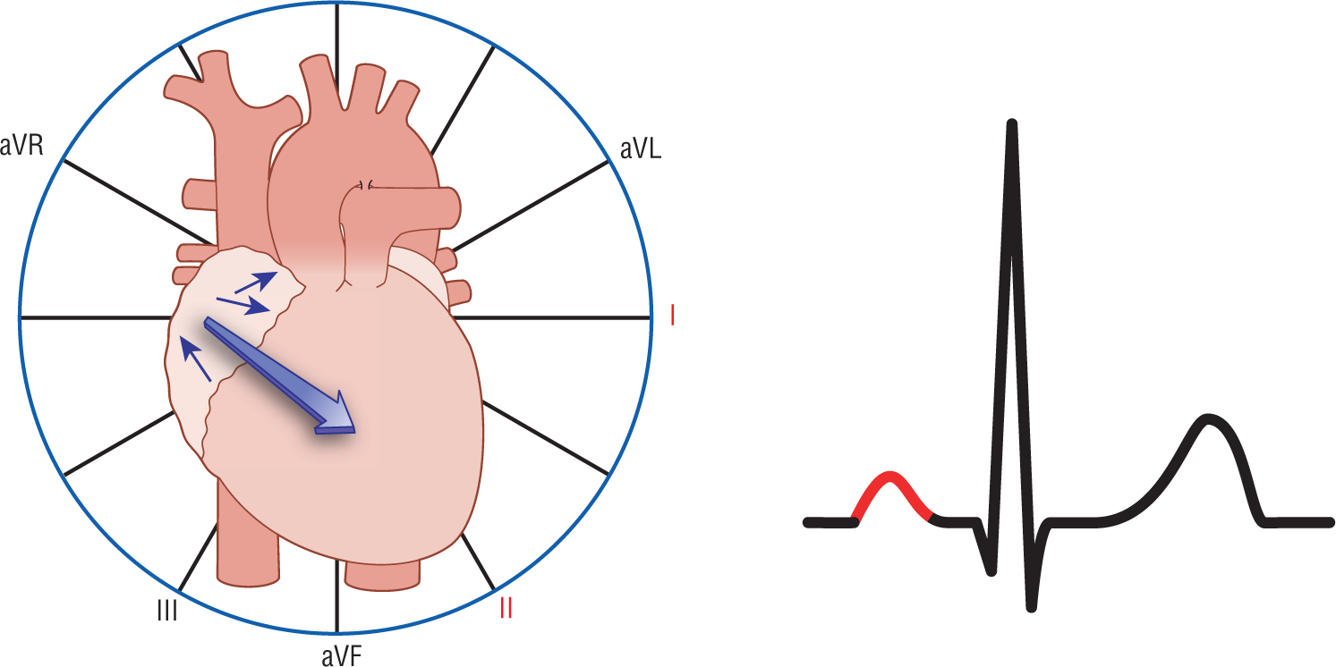 An illustration of the heart shows that the resultant vector from the right atrium points downward and to the left. Leads 1 and 2 are highlighted. In the ECG complex, the P wave is deflected upward.