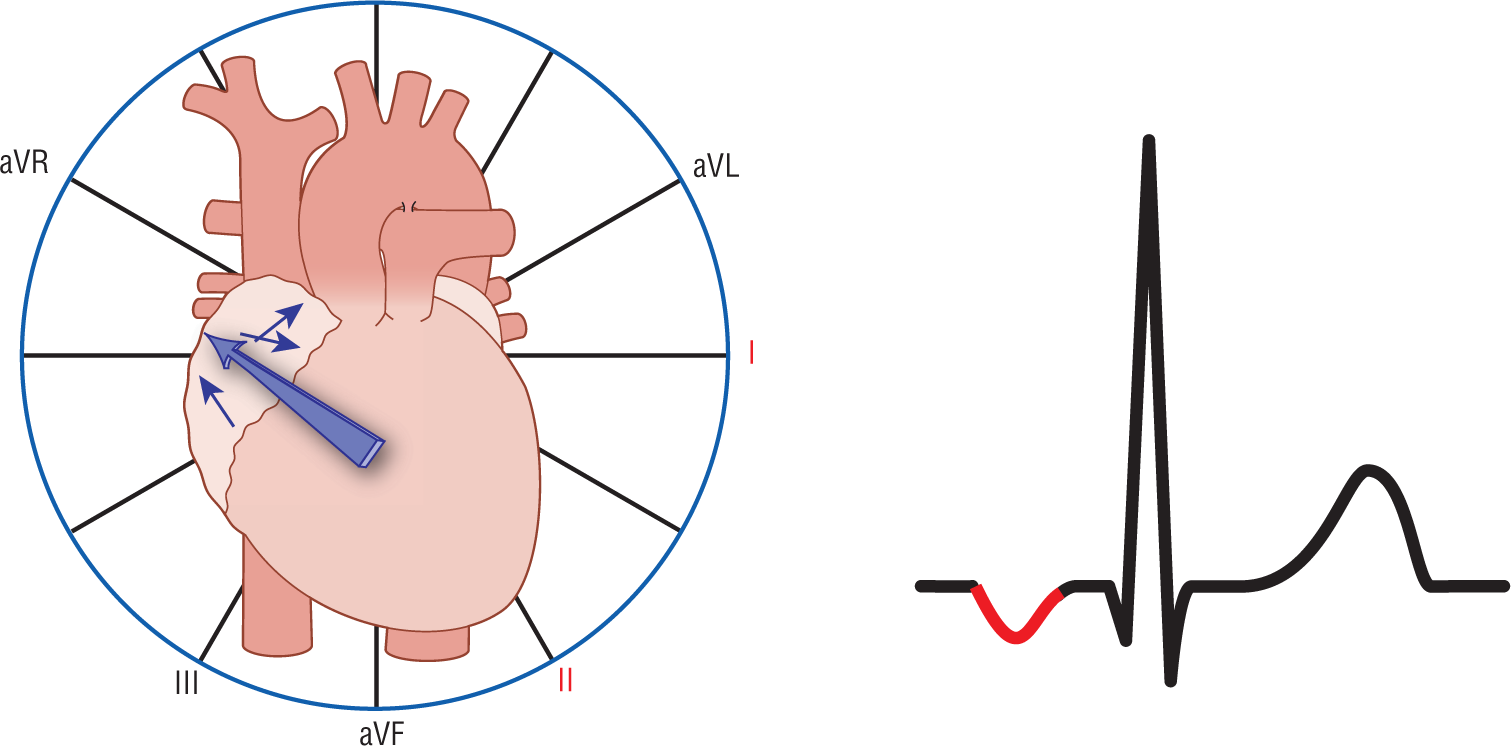 An illustration of the heart shows that the resultant vector from the right atrium points upward and to the right. Leads 1 and 2 are highlighted. In the ECG complex, the P wave is deflected downward.