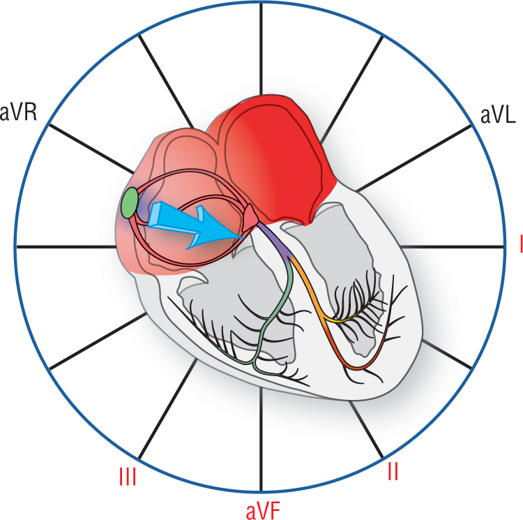 An illustration of the electrical conduction system of the heart shows the atria highlighted. A vector from the SA node points toward AV node. Leads 1, 2, 3, and aVF are highlighted.