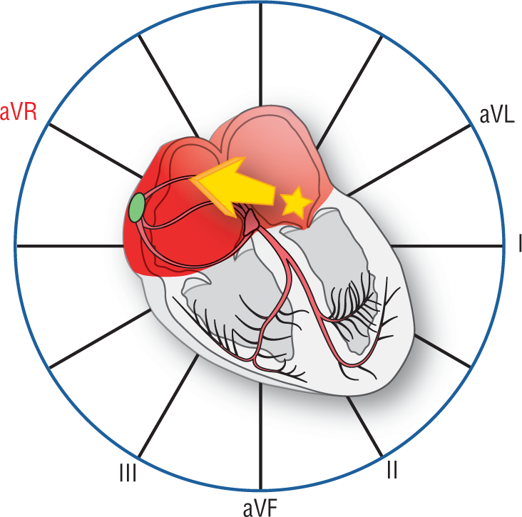 An illustration of the electrical conduction system of the heart shows the atria highlighted. A vector from the ectopic focus points toward SA node. Lead aVR is highlighted.