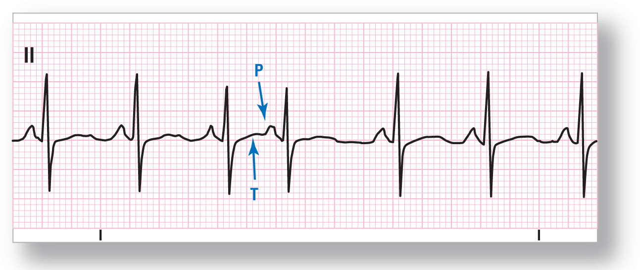 A rhythm strip from lead 2 shows a curved and short peak of the P wave, a sharp peak of the R wave, a sharp dip of the S wave, and a region of flatness for the T wave.