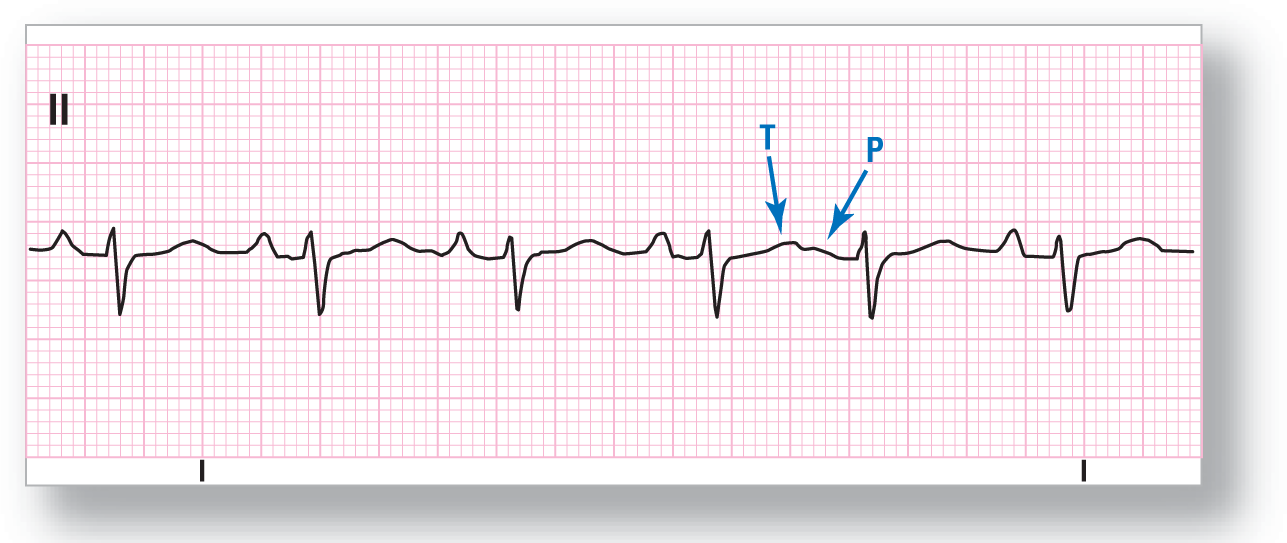 A rhythm strip from lead 2 illustrates superimposition of P wave on the previous T wave.