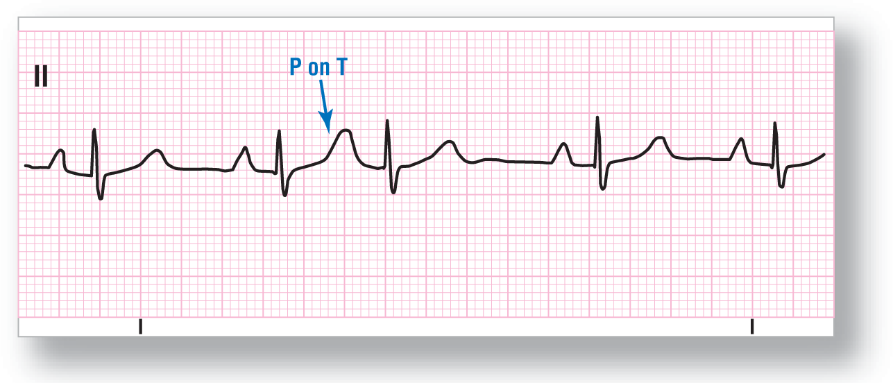 A rhythm strip from lead 2 illustrates superimposition of P wave on the previous T wave.