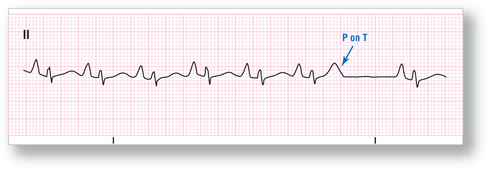 A rhythm strip from lead 2 illustrates a blocked P wave.