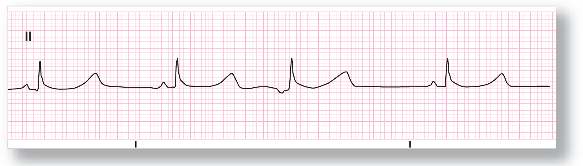 A rhythm strip from lead 2 illustrates sinus bradycardia with a PAC.