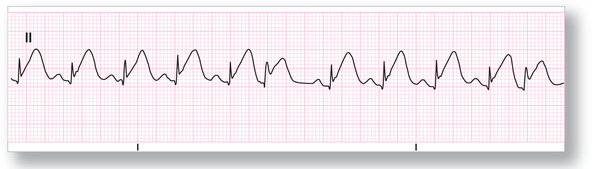 A rhythm strip from lead 2 illustrates sinus tachycardia with frequent PACs.