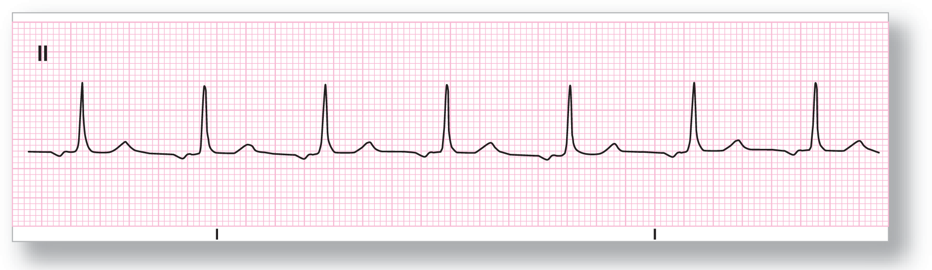 A rhythm strip shows a subtle and curved dip of the P wave, a sharp peak of the QRS complex, and a curved peak of the T wave.