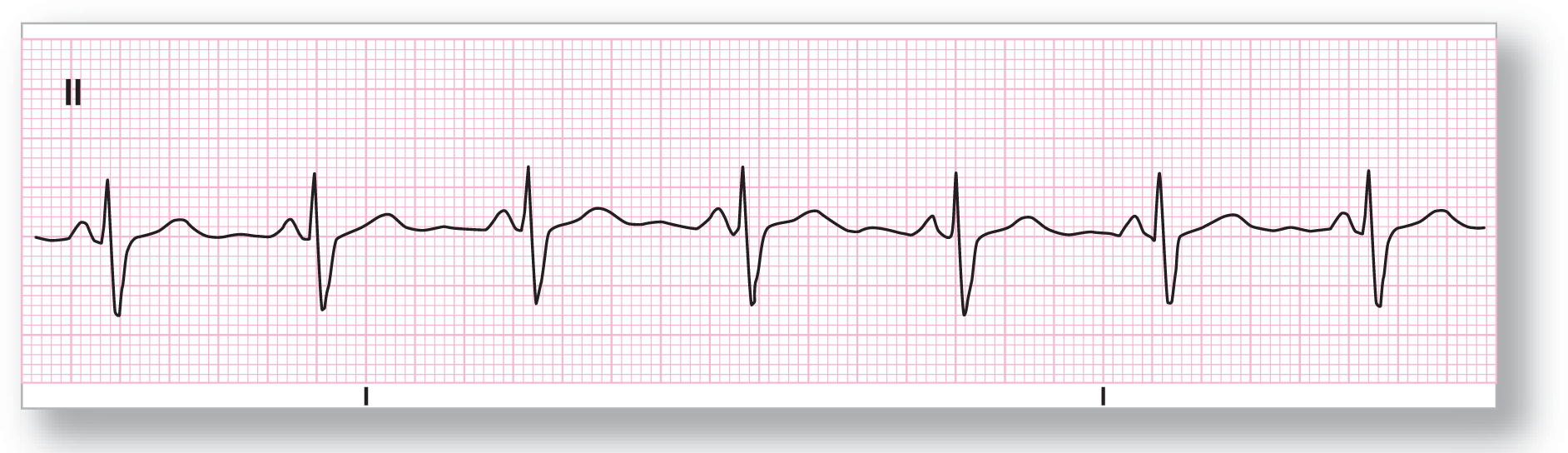 A rhythm strip shows a short, curved peak of the P wave, a sharp peak of the R wave, a sharp dip of the S wave, and a wide, curved peak of the T wave.