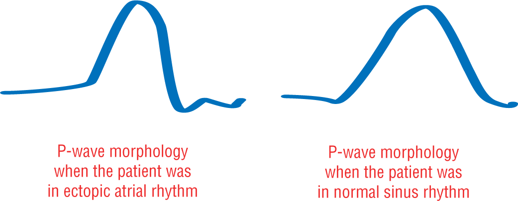 An illustration shows the P wave morphologies for ectopic and normal sinus rhythms.