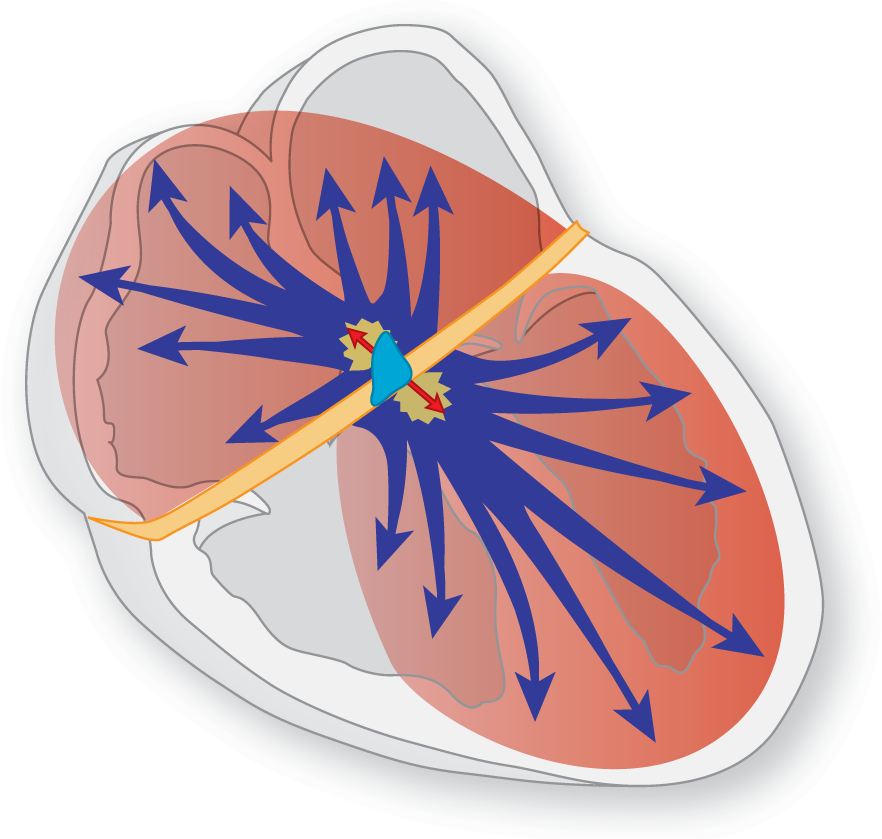 An illustration of the heart shows an impulse from the AV node spreading throughout the right atrium and left ventricle, and portions of left atrium and right ventricle.