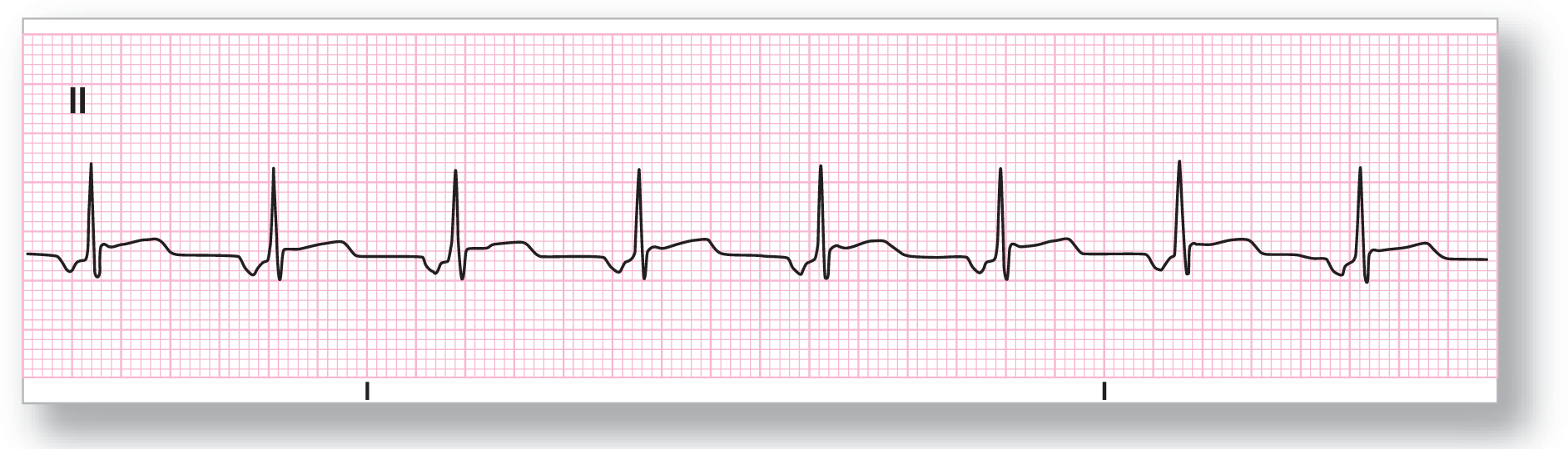 A rhythm strip from lead 2 shows a curved dip of the P wave, a sharp peak of the QRS complex, and a wide peak of the T wave. The complexes occur at regular intervals.