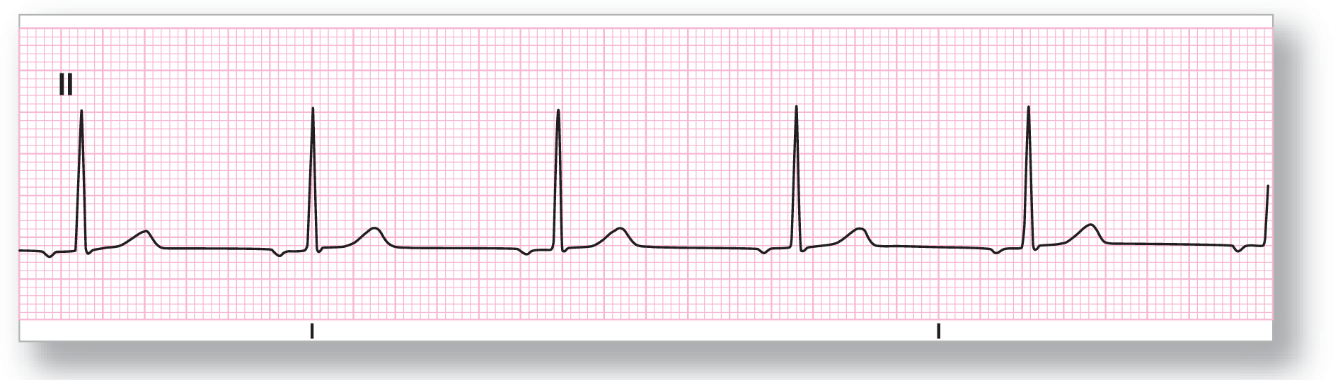 A rhythm strip from lead 2 shows a subtle and curved dip of the P wave, a tall, sharp peak of the QRS complex, and a wide, curved peak of the T wave.