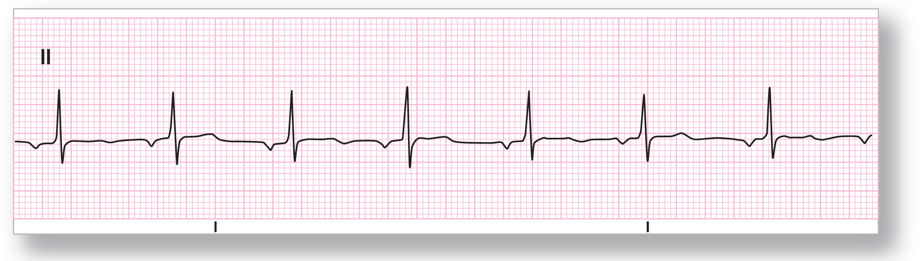 A rhythm strip from lead 2 shows a subtle and curved dip of the P wave, a sharp peak of the R wave, a sharp dip of the S wave, and a subtle, wide, and curved dip of the T wave.