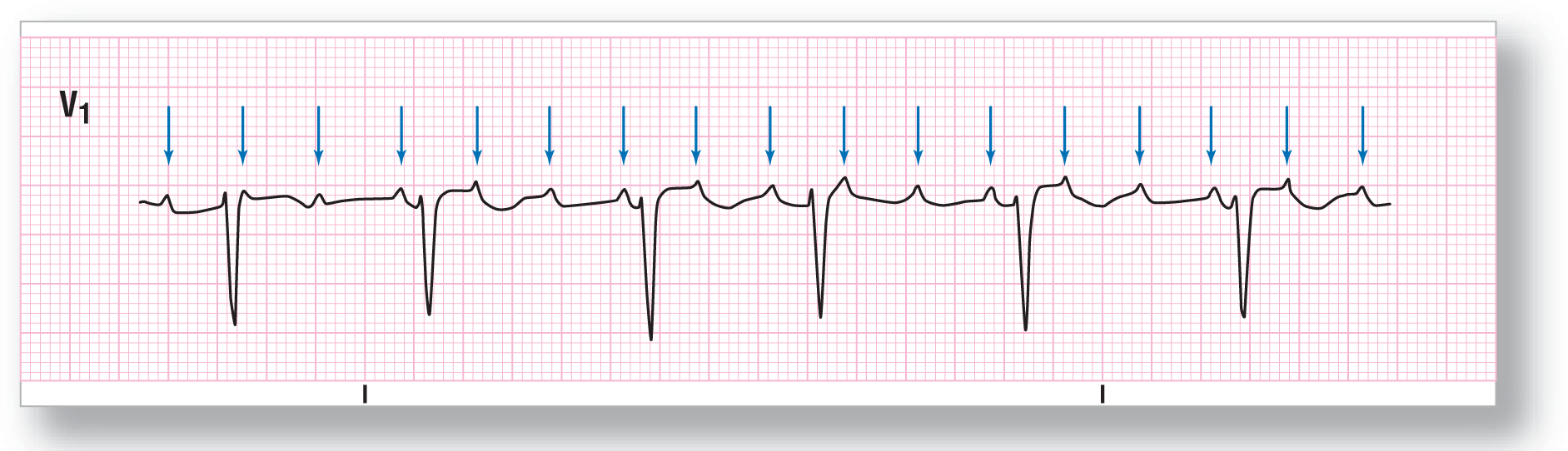 A rhythm strip from lead V1 shows deep and sharp dips of the QRS complex and small and subtle peaks of the P waves, occurring after the QRS complex and pointed by arrows.