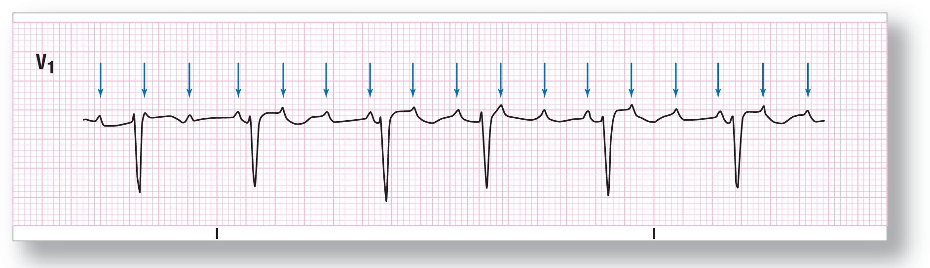 A rhythm strip.