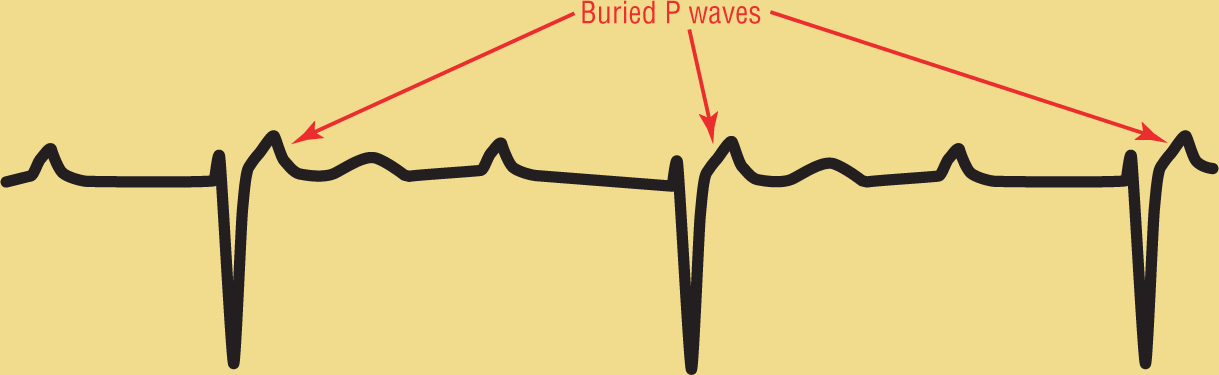 An illustration of an ECG pattern shows buried P waves occurring right after the dip of the QRS complex. Another P wave occurs after the T wave, followed by a long PR interval.