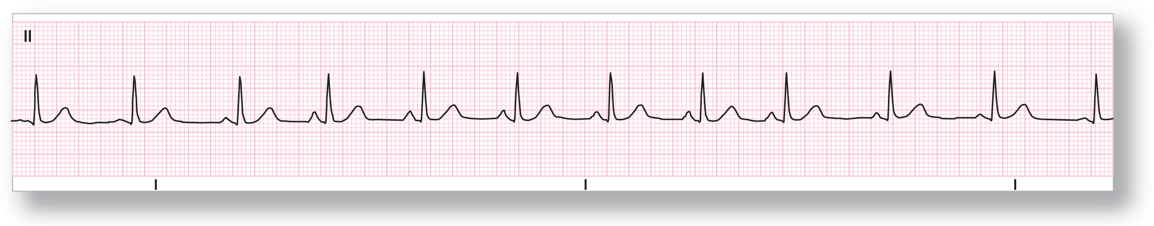 A rhythm strip from lead 2 shows a peak corresponding to QRS complex and a wide peak corresponding to T wave. As the wave progresses, the size of the P wave and the frequency increases. Later, they decrease.