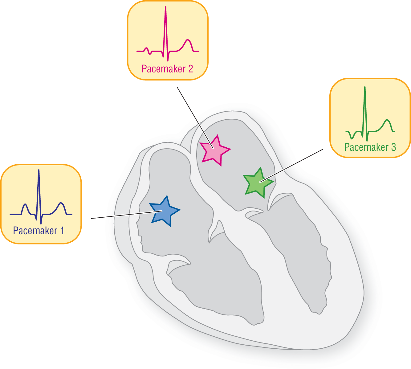 An illustration shows the pattern of the ECG waveform when pacemakers are in different locations.