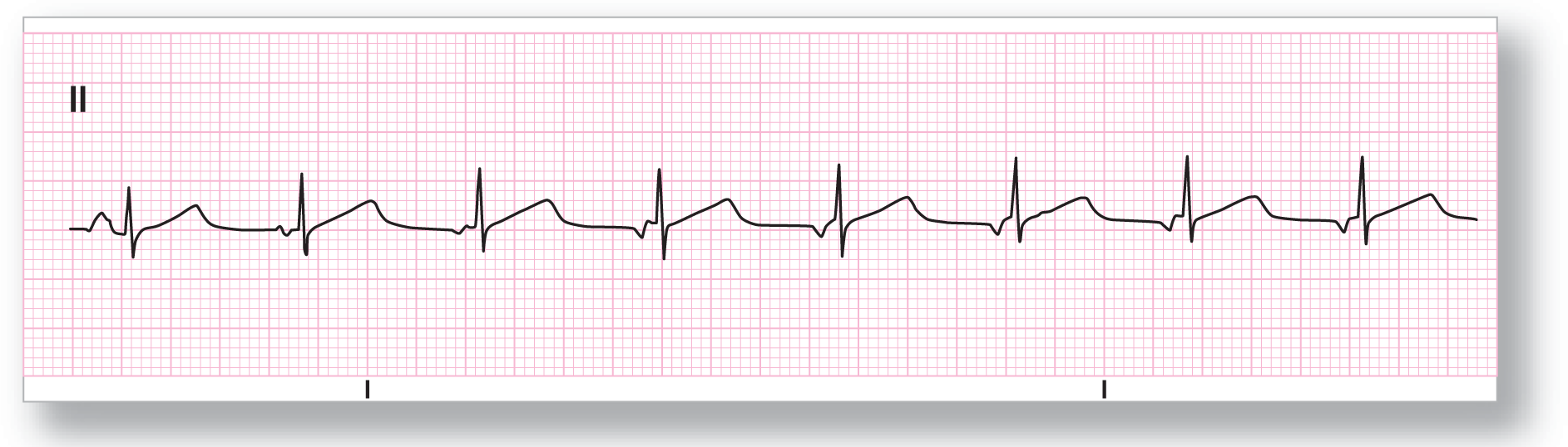 A rhythm strip from lead 2 shows a sharp dip of the QRS complex and a wide and curved peak of the T wave. The P waves initially peak and then dip.