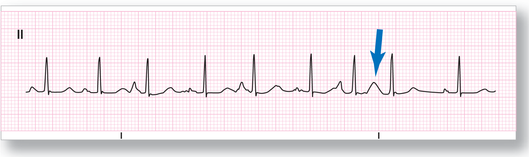 A rhythm strip from lead 2 shows a sharp peak of the QRS complex, a small and sharp peak of the P wave, and a wide and curved peak of the T wave. An arrow points toward a fusion of P and T waves.