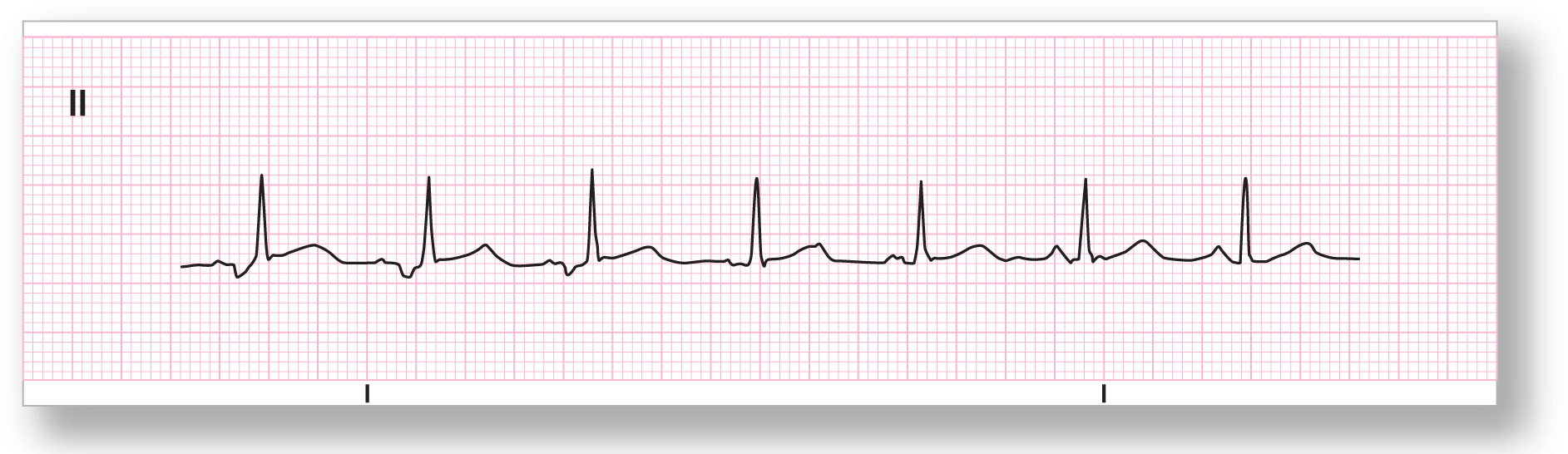 A rhythm strip from lead 2 shows a waveform with different morphologies for P waves.