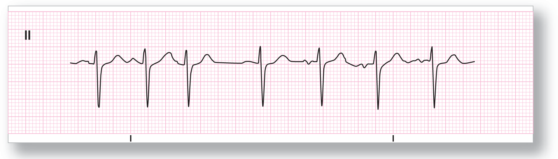 A rhythm strip from lead 2 shows a waveform with different morphologies for P waves.