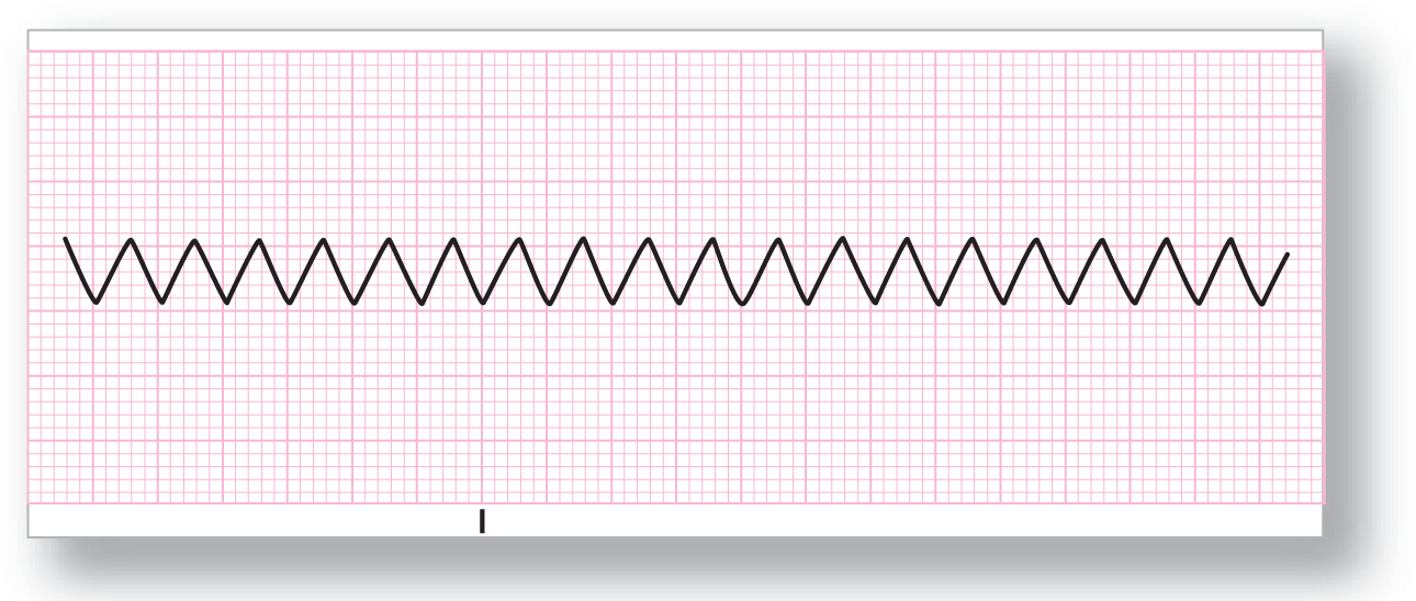 A rhythm strip shows a sawtooth wave.