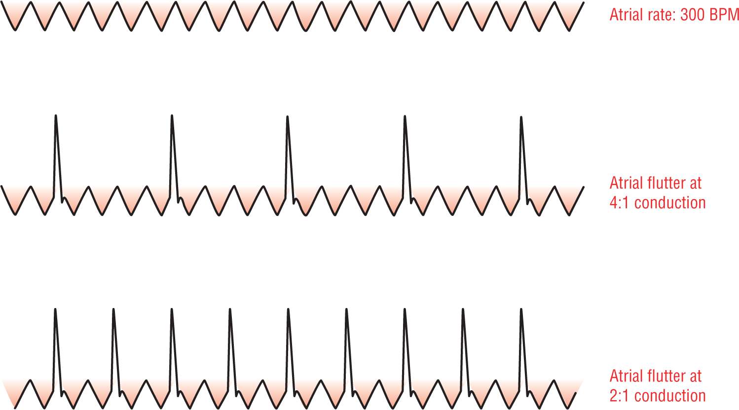 An illustration shows three rhythm patterns, demonstrating ventricular response in atrial flutter.