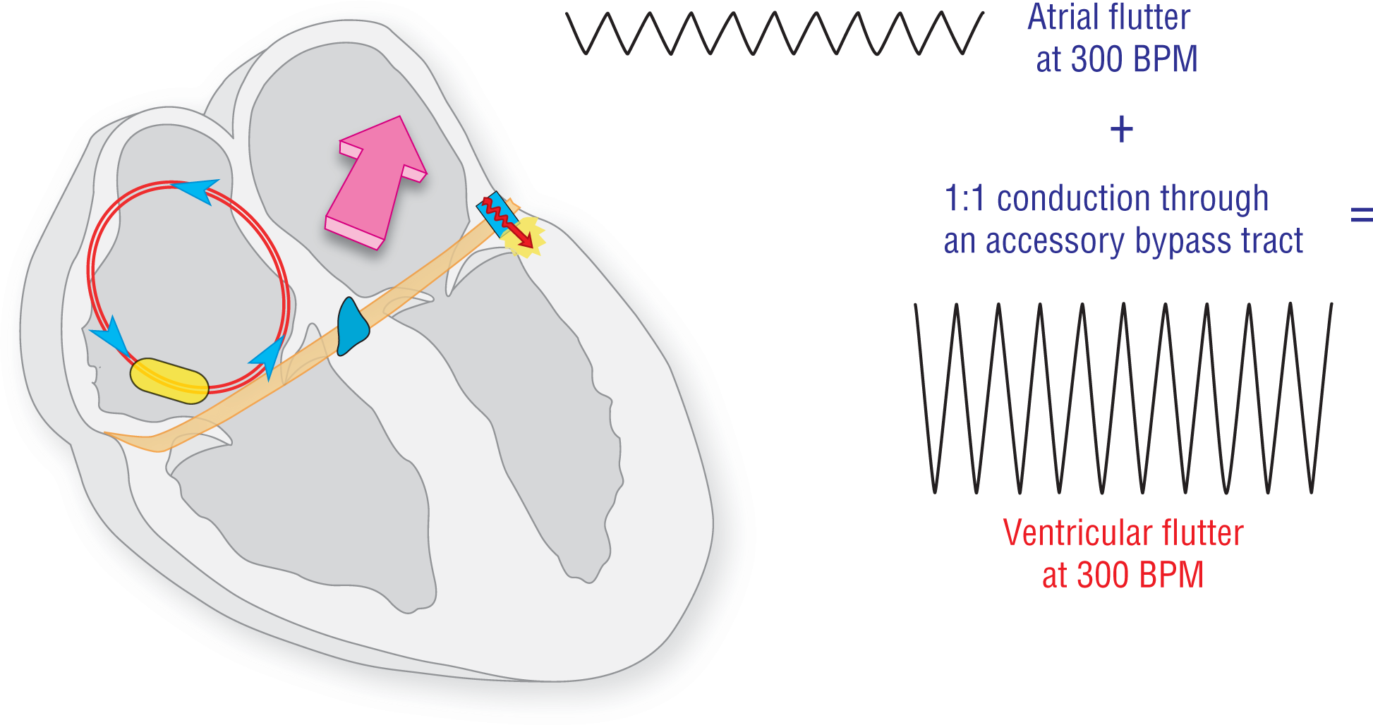 An illustration depicts one-to-one conduction in the atria.