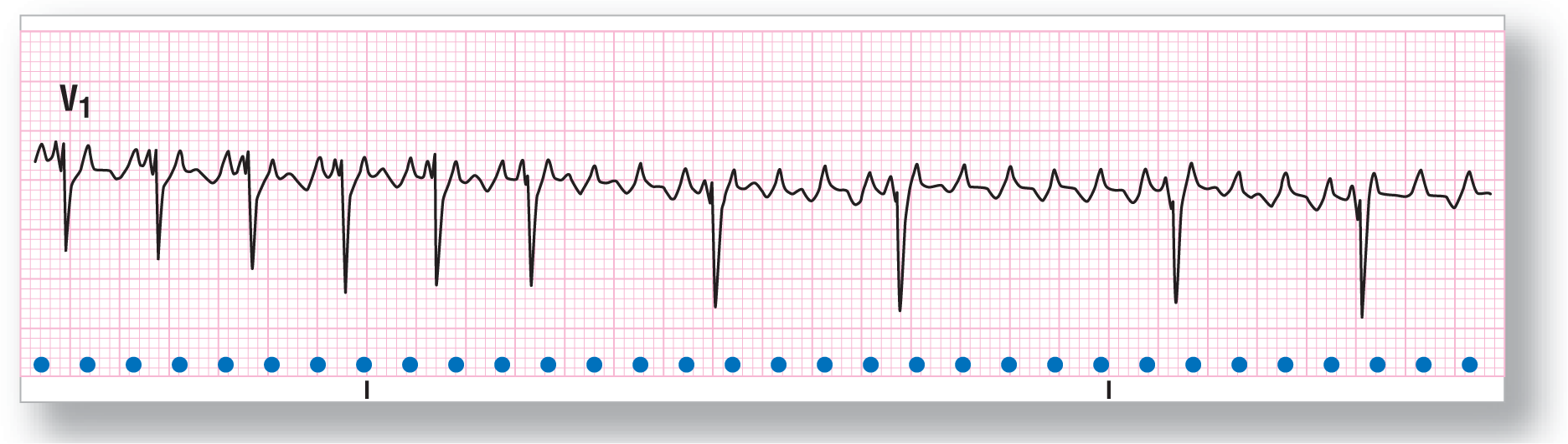 A rhythm strip from lead V1 shows peaks that fall to plateau and then to the baseline. Sharp dips occur at irregular intervals, corresponding to different conduction rates.