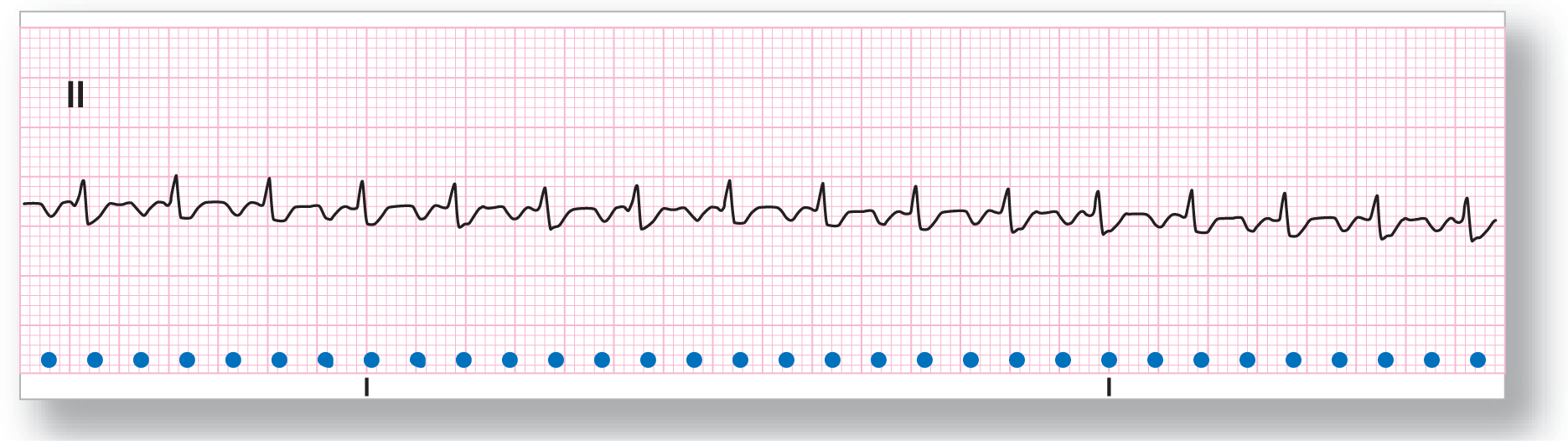 A rhythm strip from lead 2 shows a small dip of the P wave and a small peak of the QRS complex, followed immediately by a small dip of the F wave. F wave is at the halfway point of the P-P interval.