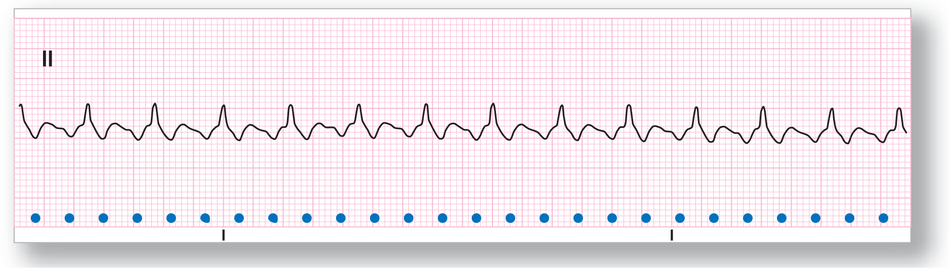 A rhythm strip from lead 2 shows a sharp peak and a shorter and broad peak occurring at a regular rate.