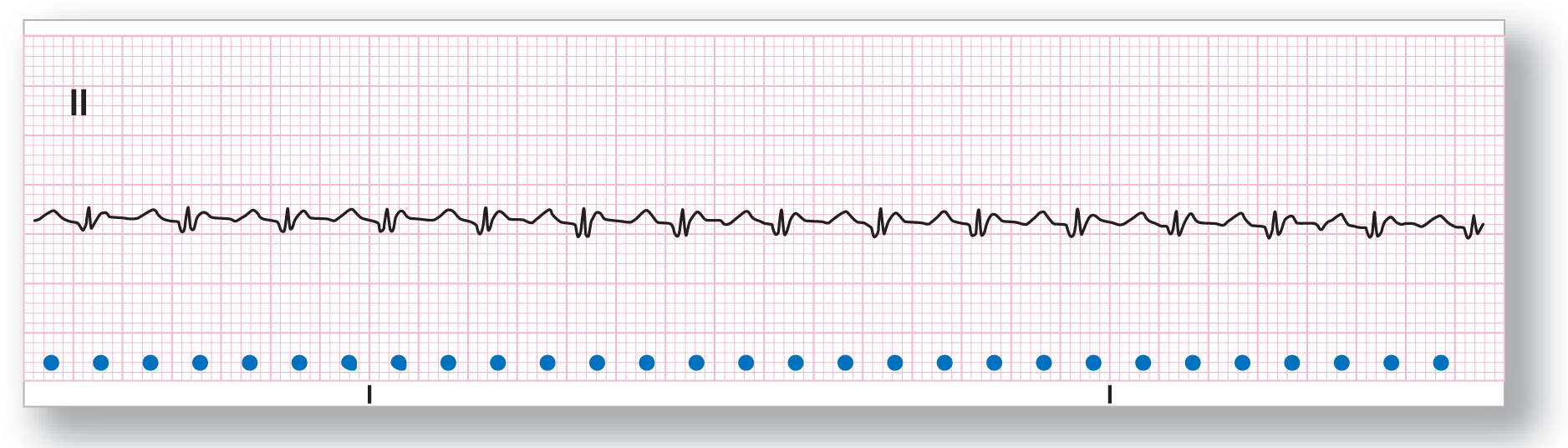 A rhythm strip from lead 2 shows small and narrow peaks of the QRS complexes, with F waves and buried F waves on its either side.